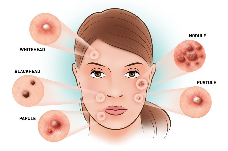 pimple treatment in bhopal